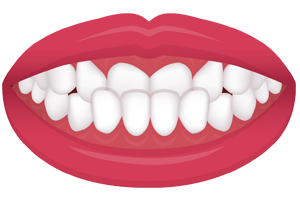 teeth-crossbite