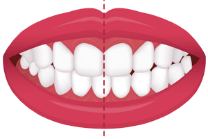 teeth-midline-shift