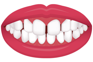 teeth-spacing